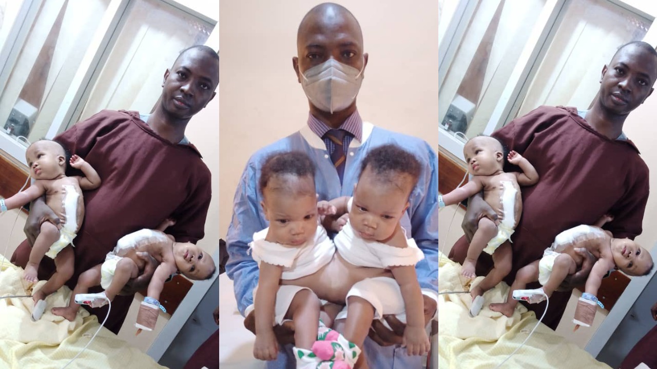 Conjoined twins successfully separated at the University of Ilorin Teaching  Hospital (Photos) | LuciPost